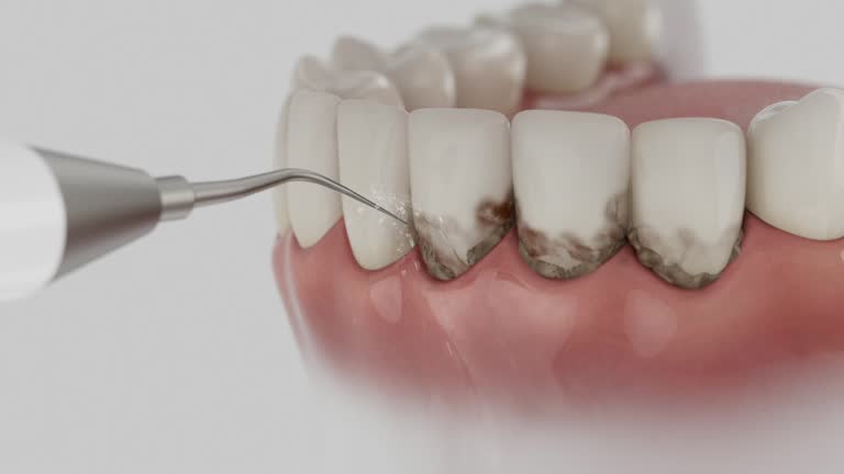 Trusted Wisdom Tooth Removal service in Country Club Hills, MO - Dentist Open Now